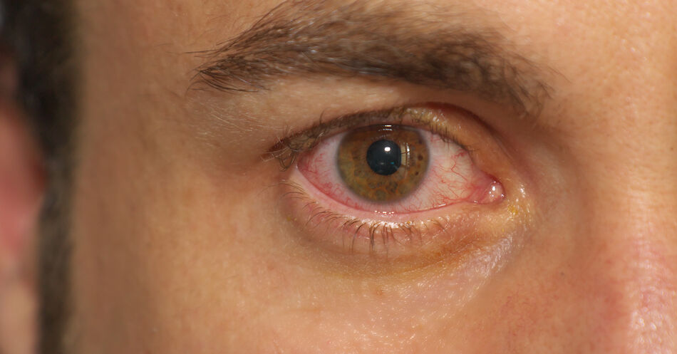 Irisfarbe: Mehr Aderhaut-Tumoren bei hellen Augen, mehr Grauer Star bei dunklen Augen