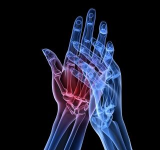 Schuppenflechte in Gelenken: Neue Therapien bei Psoriasis-Arthritis