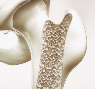 Vitamin D-Mangel begünstigt Ausbildung von Osteoporose